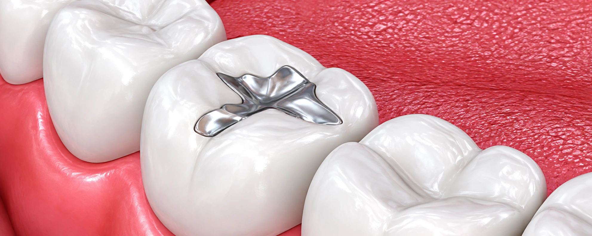 Dental Filling Cost in JB