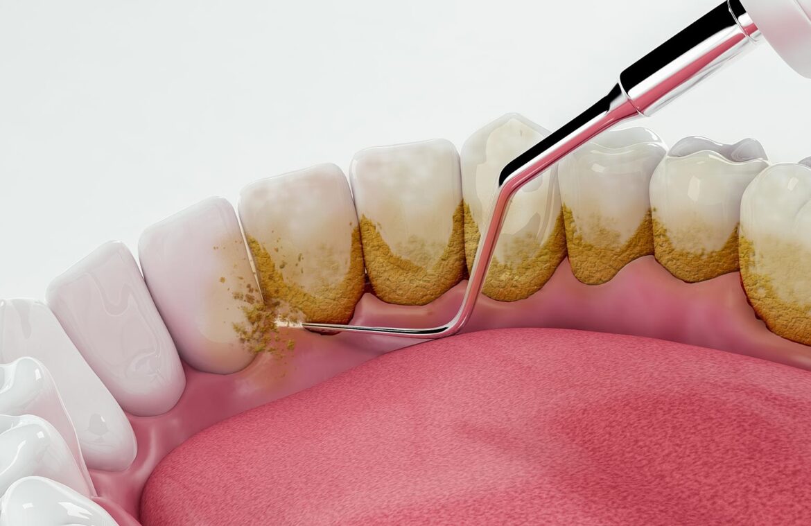 scaling and polishing in jb
