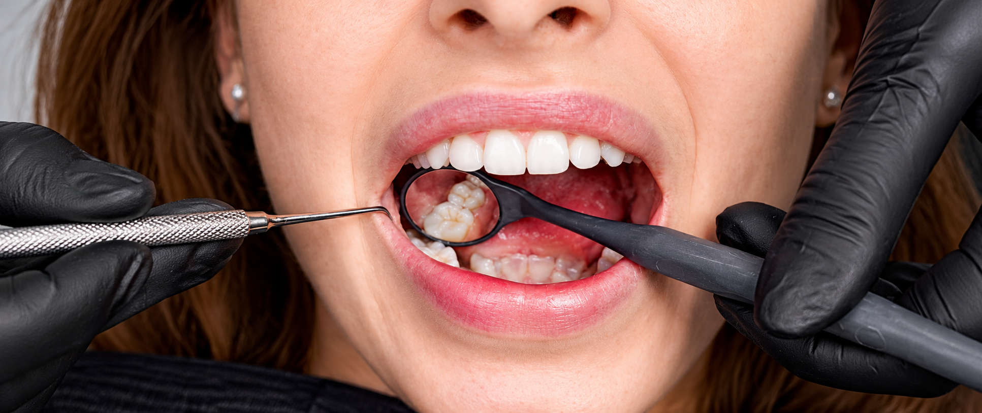 Wisdom Tooth Extraction Procedure in Johor Bahru